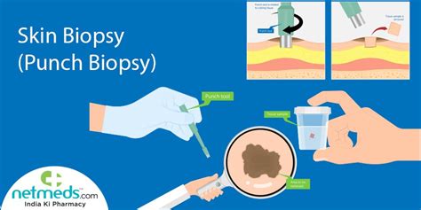 Skin Biopsy: Procedure, Risks And Results