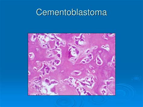 Cementoblastoma Histology