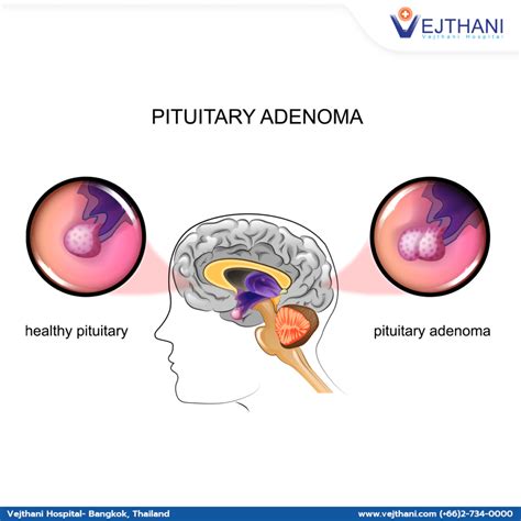 "Understanding Pituitary Adenomas: Overview of Symptoms, Diagnosis, and ...