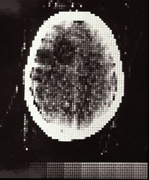 First CT Scan - October 1971 - radRounds Radiology Network