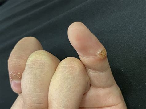 Effective Treatment: Common Wart on Finger – CS Blog