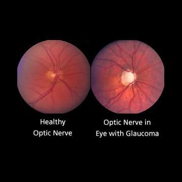 Optic Nerve Cupping - Glaucoma Research Foundation