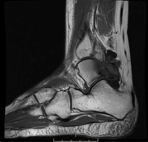 Subchondral cyst | BoneTumor.org