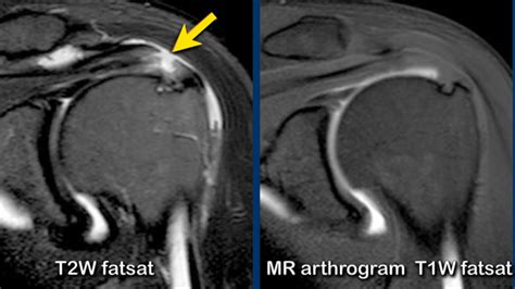 The Radiology Assistant : Shoulder - Rotator cuff injury