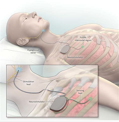 inspire sleep apnea doctors near me - Cathie Dickinson