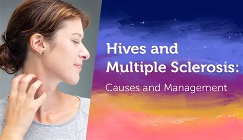 Understanding MS and Hives: Tips for Relief | MyMSTeam