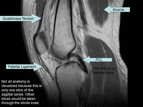 Knee Muscle Anatomy Mri : Scroll through the structures to understand ...