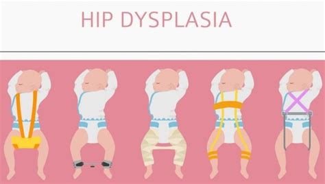 The Journey Of Infant Hip Dysplasia: From Diagnosis to Management ...