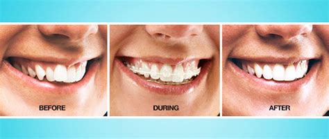 Six Month Smiles - Levenshulme Dental & cosmetics - A new smile in only ...