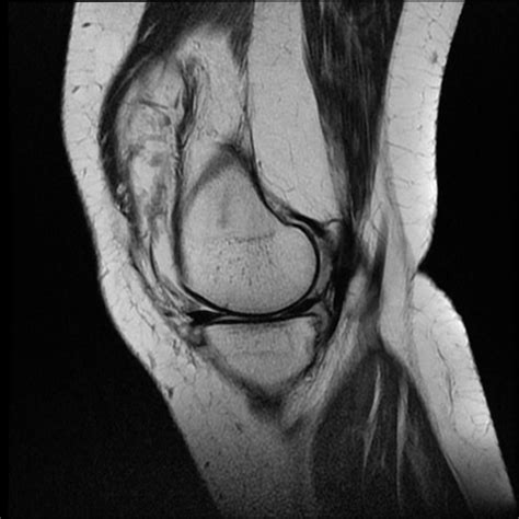 Rheumatoid arthritis MRI - wikidoc