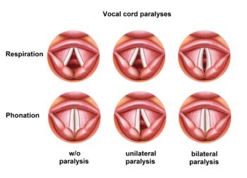 Vocal cord paresis - Wikipedia