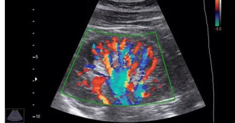 Colour Doppler Test Cost | Colour Doppler Ultrasound Price | Near Me