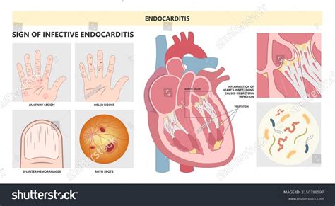 18 Janeway Lesions Images, Stock Photos & Vectors | Shutterstock