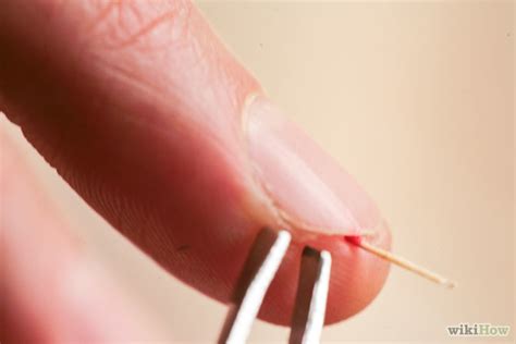 How to Remove a Splinter Under Your Fingernail: 12 Steps