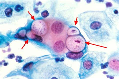 Chlamydia Trachomatis - Causes, Symptoms, Diagnosis, Treatment