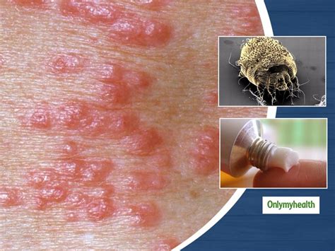 What Is Scabies? Learn About Its Causes, Symptoms And Treatment ...