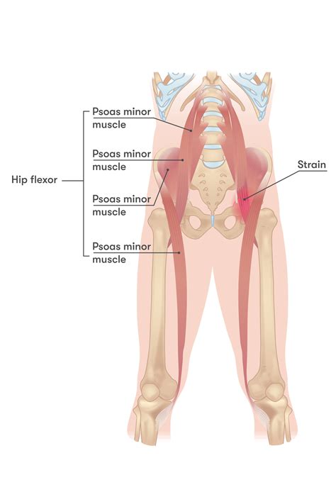 Hip Flexor Pain Causes