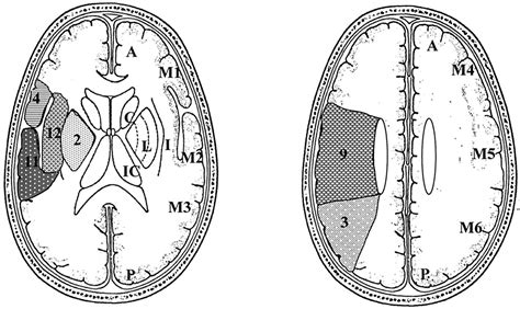 Hyperdense Sylvian Fissure MCA “Dot” Sign | Stroke