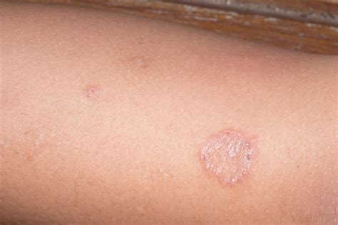 Is It Ringworm? Signs and Symptoms