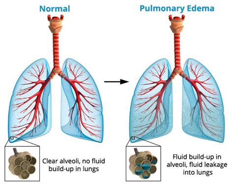 pulmonary edema - Google Search | NCLEX | Pinterest | Pulmonary edema ...