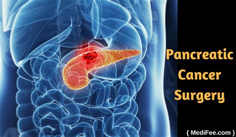 Pancreatic Cancer Treatment: Surgery Types, Risks & Recovery