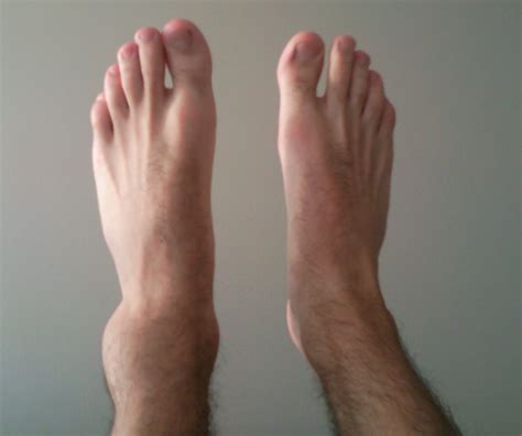 File:Sprained ankle 30min.jpg