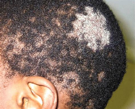 Some Scalp Disorders You Should Know About For Your Hair Health