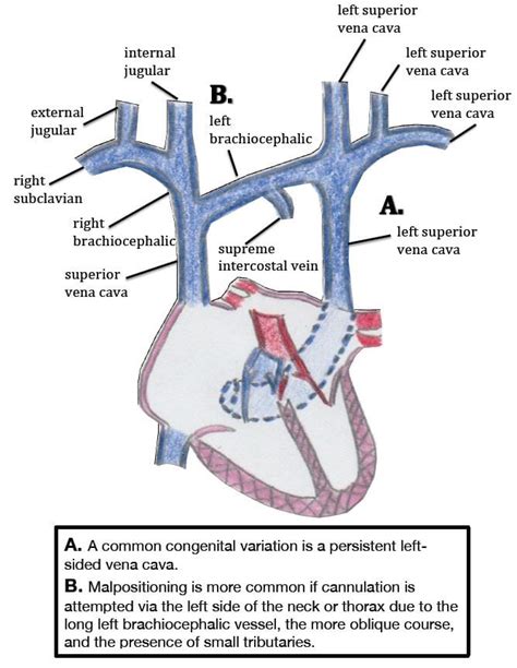 Central Venous Catheter Intravascular Malpositioning: Causes ...