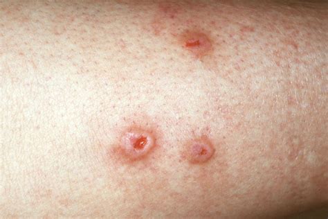 prurigo nodularis treatment - pictures, photos