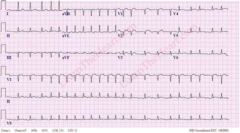 Atrial Fibrillation With Slow Ventricular Response