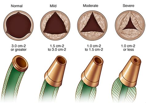 Aortic Valve Stenosis - Causes, Symptoms, Life Expectancy, Treatment