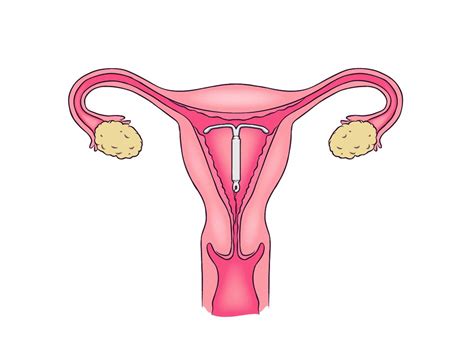 What's an IUD insertion like?