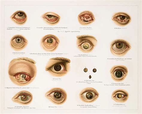 Human eye diseases lithograph 1896 (Photos Framed, Prints, Puzzles ...