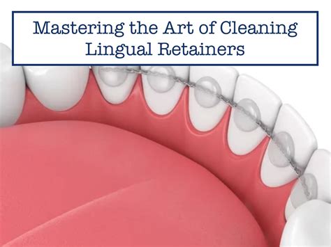 Mastering the Art of Cleaning Lingual Retainers