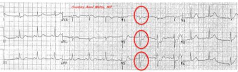 Posterior Myocardial Infarction: How Accurate is the Flipped ECG Trick?