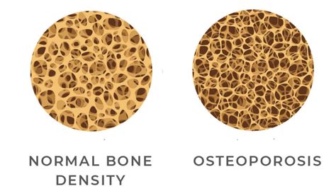 image showing normal bone density vs. osteoporosis - Imaging Center ...