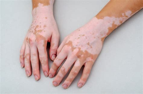 Vitiligo: o que é, sintomas, tratamentos e causas - São Gabriel