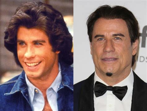 John Travolta plastic surgery Botox and hair transplant?