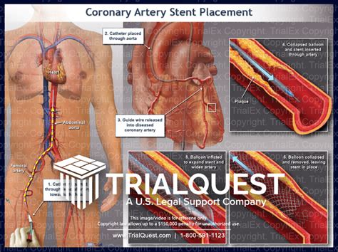 Coronary Artery Stent Placement