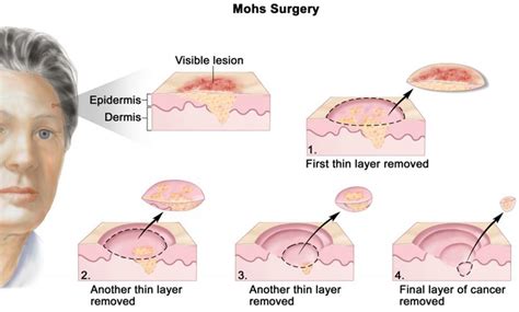 Mohs Case Before & After - Infiltrative Basal Cell Carcinoma