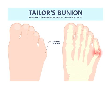 Bunion on the Little Toe: Causes, Symptoms, and Treatment Options ...