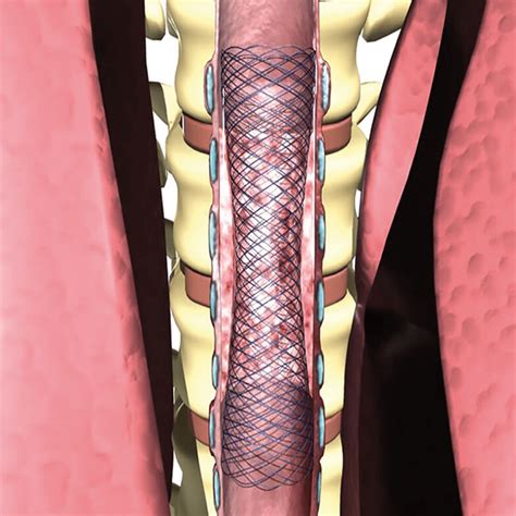 Tracheal- und Bronchial-Stents : Heintel