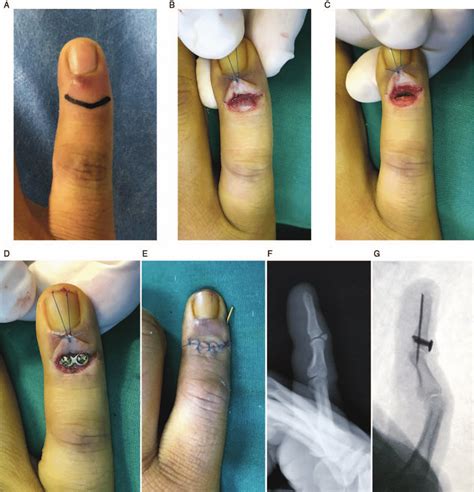 Treatment of a mallet fracture that involved the little finger with a ...