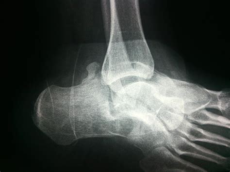 Subtalar Dislocations - Trauma - Orthobullets