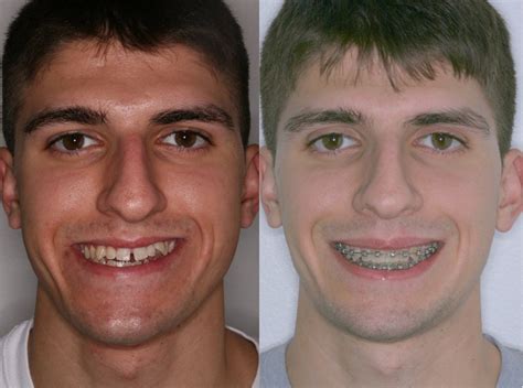 Corrective Jaw Surgery | Orthognathic Surgery | Misaligned Jaws