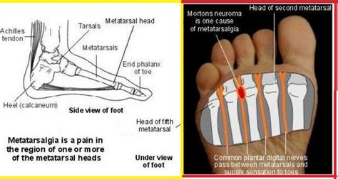 Metatarsalgia or Foot Pain - The Orthobiologic Clinic