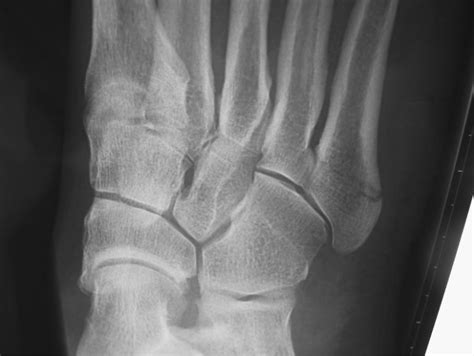 Jones Fracture: Injury Defined and Post Surgical Recovery