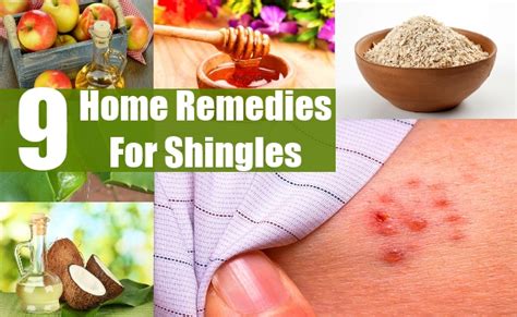 9 Home remedies for Shingles - Vistasol Medical Group