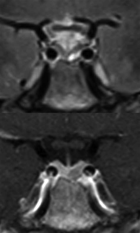 Pituitary microadenoma (prolactinoma, treated) | Treats, Mri, Bells