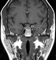 CT/MRI: Prolactinoma